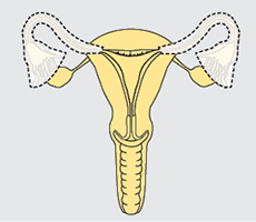 FEMALE TUBAL STERILIZATIONS (permanent birth control)